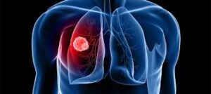 cancer tumour on lung