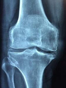 inflamed knee joint